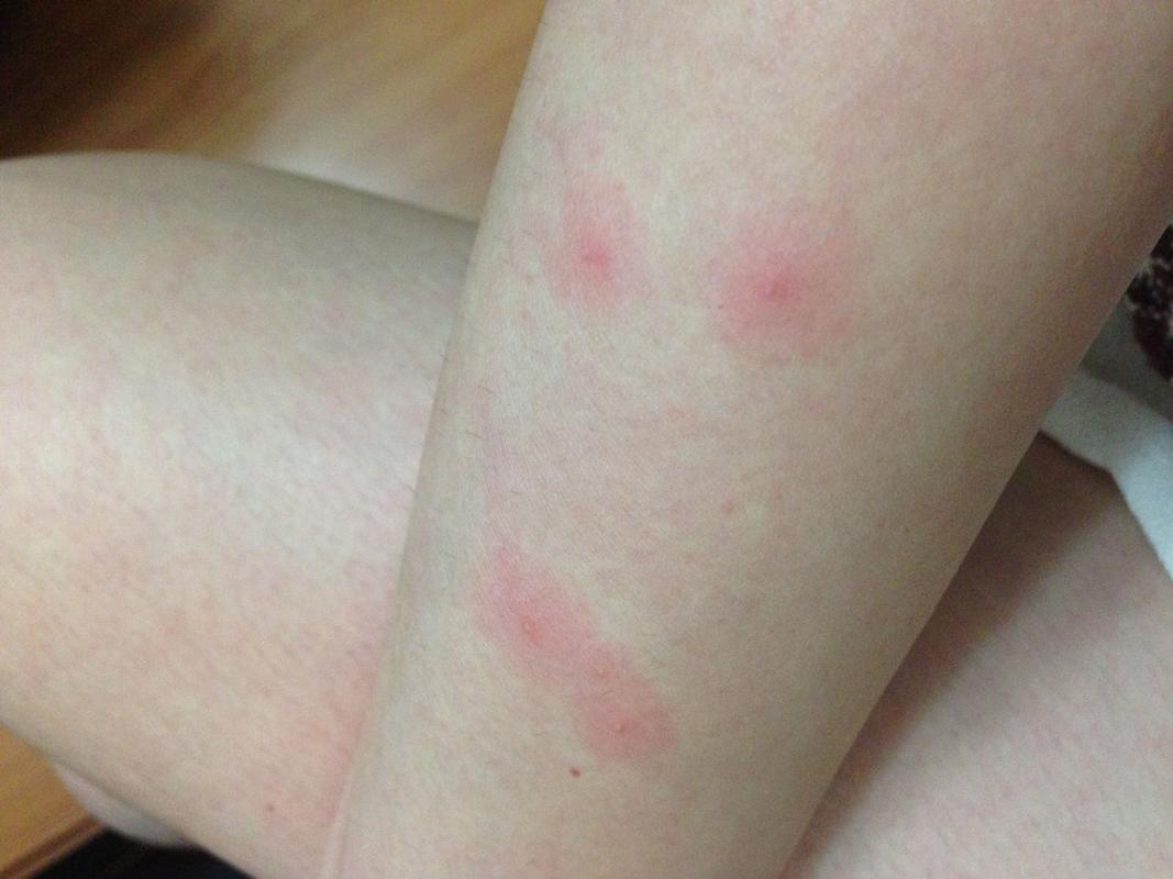 艾滋病早期皮疹特点 艾滋病初期皮疹症状