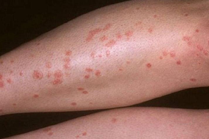 艾滋病早期皮疹特点 艾滋病初期皮疹症状